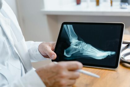 Medical illustration showing osteomyelitis bone infection diagnosis and treatment advances