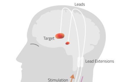 Illustration of adaptive deep brain stimulation system with neural decoding for Parkinson's disease gait improvement