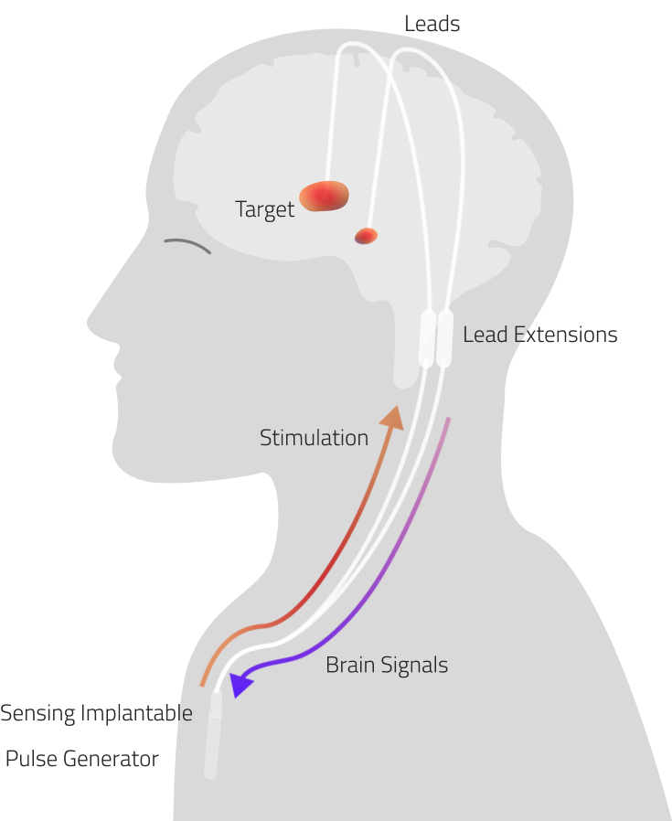 Illustration of adaptive deep brain stimulation system with neural decoding for Parkinson's disease gait improvement