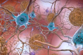 Diagram showing amyloid beta disrupting tau protein function in neurons