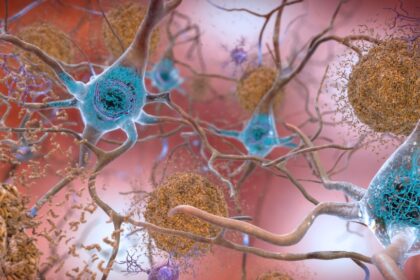 Diagram showing amyloid beta disrupting tau protein function in neurons