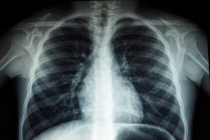 Healthcare surveillance monitoring pneumococcal disease trends in Belgium