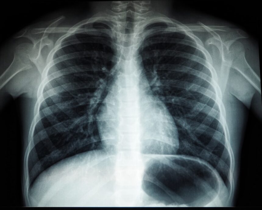 Healthcare surveillance monitoring pneumococcal disease trends in Belgium