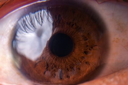 Ophthalmologic image showing diabetic retinopathy neovascularization of optic disk