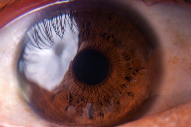 Ophthalmologic image showing diabetic retinopathy neovascularization of optic disk