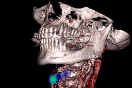 PET scan image showing blood clot detection in legs and lungs using novel radiotracer technology