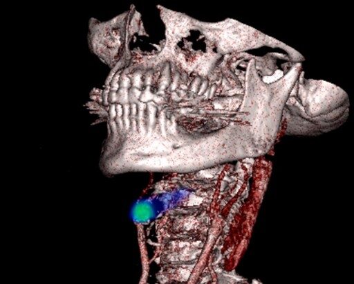 PET scan image showing blood clot detection in legs and lungs using novel radiotracer technology