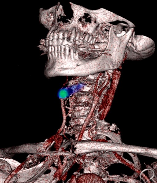 PET scan image showing blood clot detection in legs and lungs using novel radiotracer technology