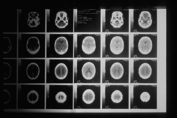 Medical illustration showing paraneoplastic neurologic syndrome affecting nervous system