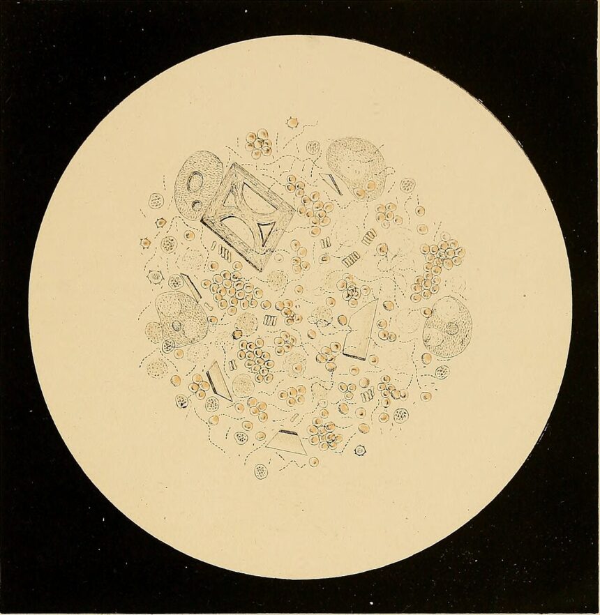 Medical illustration showing prostate gland anatomy and common symptoms of prostate cancer