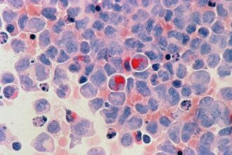 Medical illustration showing teclistamab bispecific antibody mechanism in multiple myeloma treatment