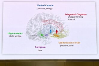 Medical illustration of enhanced deep brain stimulation electrode configuration