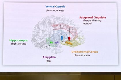 Medical illustration of enhanced deep brain stimulation electrode configuration