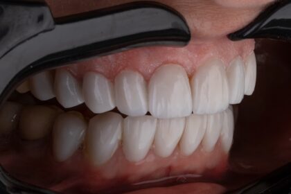 Dental anatomy diagram showing primary and permanent teeth development across the human lifespan