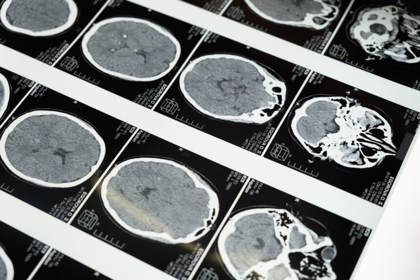 Illustration comparing visceral and subcutaneous fat distribution and their effects on brain volume
