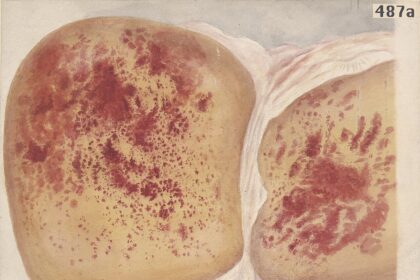 WHO World Health Assembly meeting hall during historic fatty liver disease resolution vote