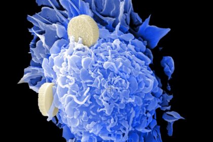 Prostate cancer risk stratification by histological grade and genetic markers