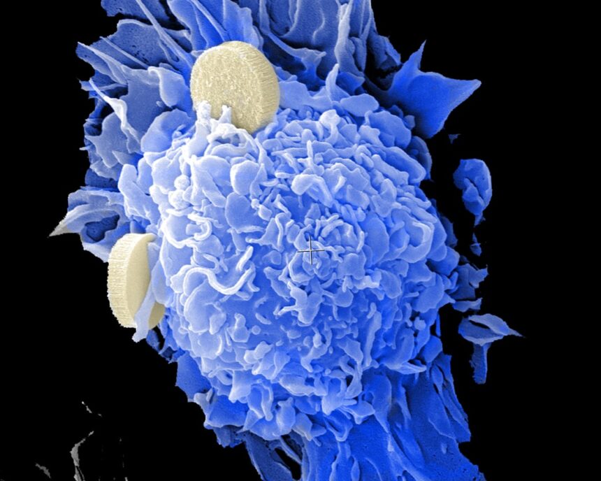 Prostate cancer risk stratification by histological grade and genetic markers