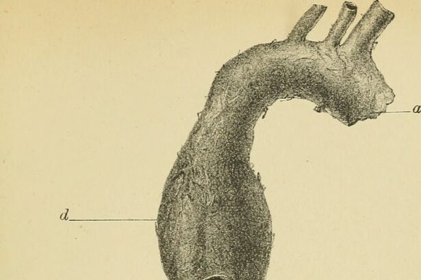 Computed tomography showing descending thoracic aortic aneurysm with surgical marking