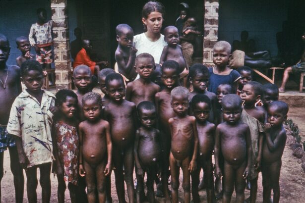 Child showing signs of kwashiorkor: bilateral oedema, hair depigmentation, and dermatitis from severe protein malnutrition