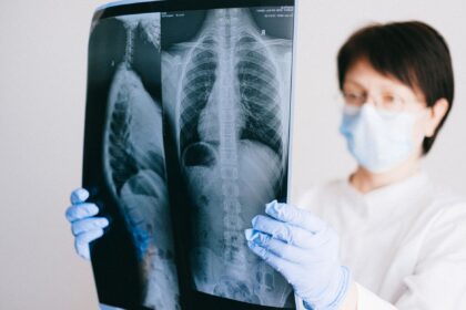 Mobile CT scanner unit in community setting screening for early-stage lung cancer
