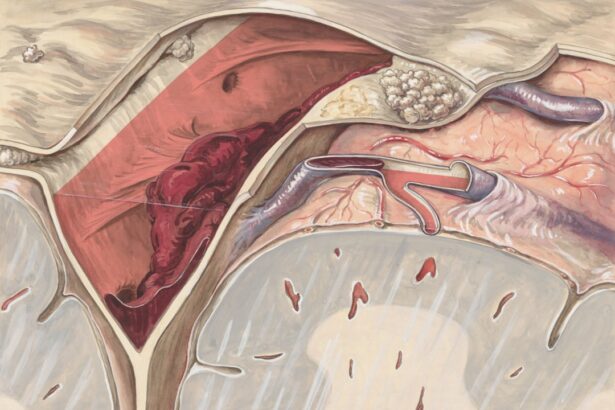Illustration comparing atherosclerotic plaque versus small vessel enlargement in cerebral arteries