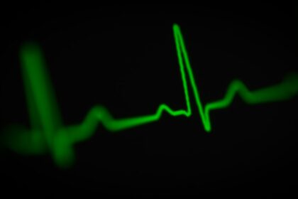 ECG showing ventricular arrhythmia pattern in syncope patient