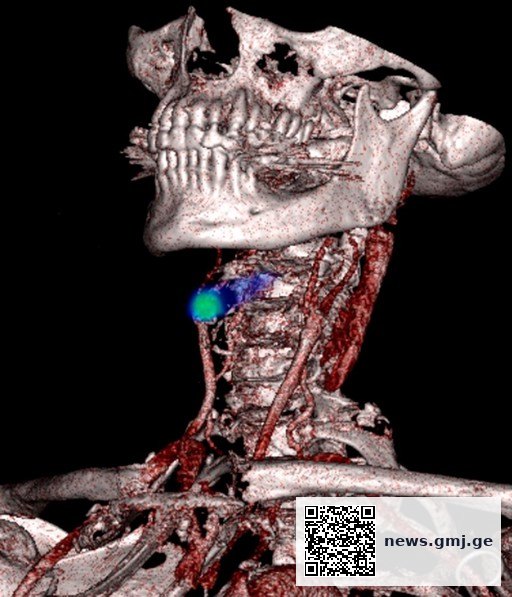 PET scan image showing blood clot detection in legs and lungs using novel radiotracer technology