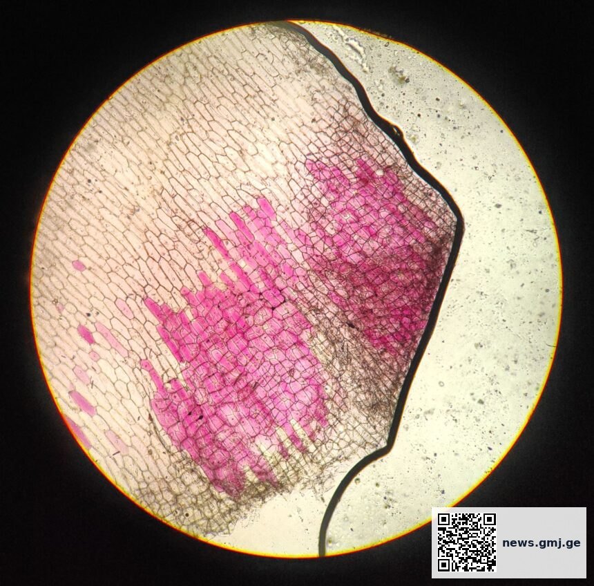 Medical illustration showing Schwann cells surrounding nerve fibers with GDNF protein signaling pathways