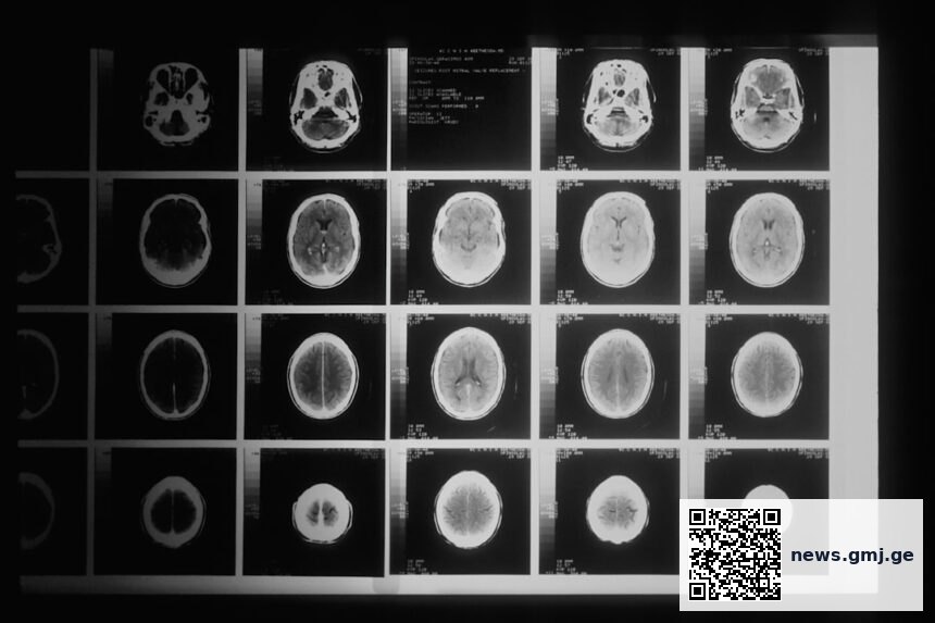 Medical illustration showing paraneoplastic neurologic syndrome affecting nervous system