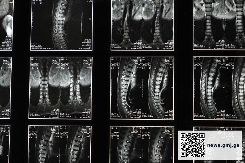 Illustration of spinal cord and segmental nerve distribution from cervical to sacral regions