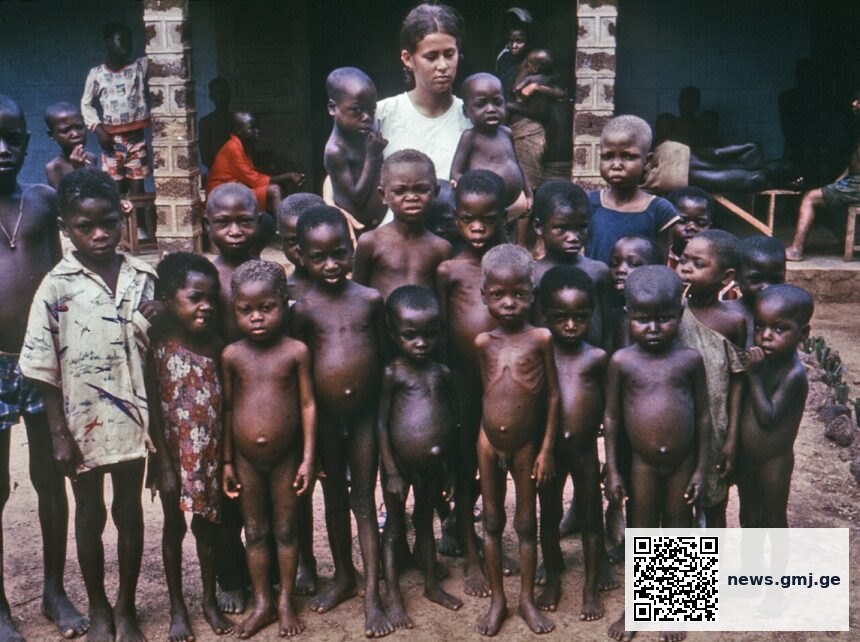 Child showing signs of kwashiorkor: bilateral oedema, hair depigmentation, and dermatitis from severe protein malnutrition