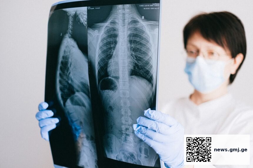 Mobile CT scanner unit in community setting screening for early-stage lung cancer