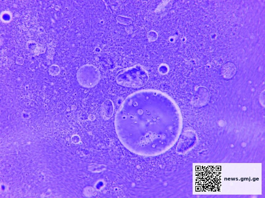 Illustration of CD8+ T cell infiltration and cytokine-mediated activation in lupus-affected kidney tissue